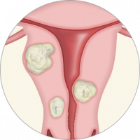 fibroids1